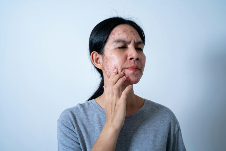 Acne on face because the disorders of sebaceous glands productions. Acne or a Cosmetic