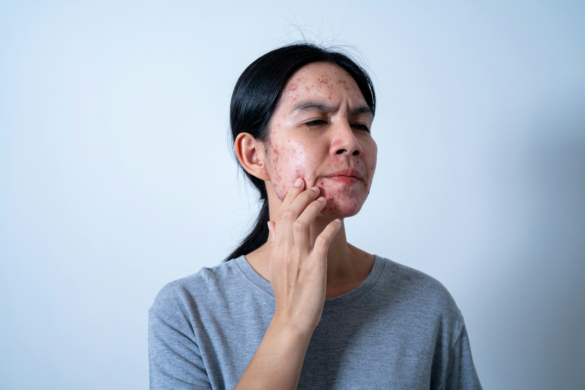 Acne on face because the disorders of sebaceous glands productions. Acne or a Cosmetic